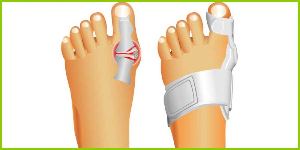 Hallux Valgus Schiene Hallux Valgus Schuhe