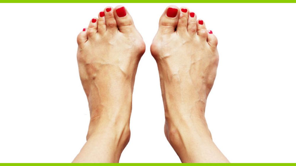 Hallux Valgus Entstehung und Ursache