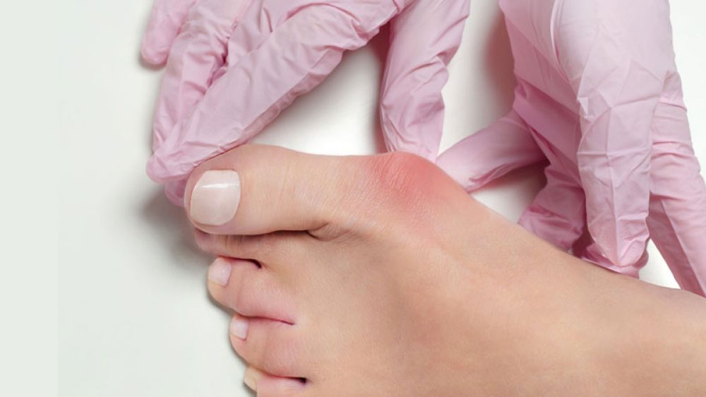 Hallux Valgus OP mit winkelstabiler Platte