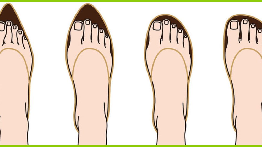 Schuhweite und Schuhlänge bei Hallux Valgus