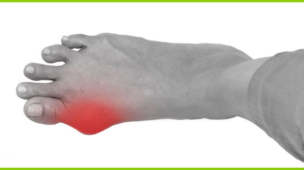 Was ist ein Hallux Valgus?