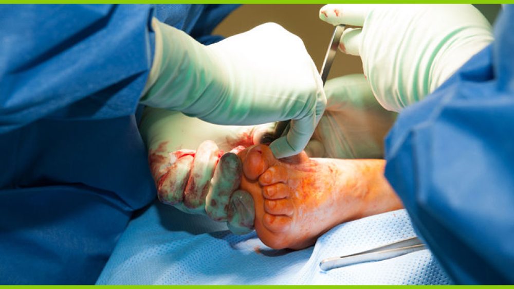 Moderne Hallux Valgus OP