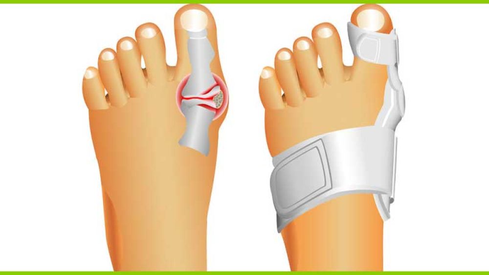 Hallux Valgus Schiene