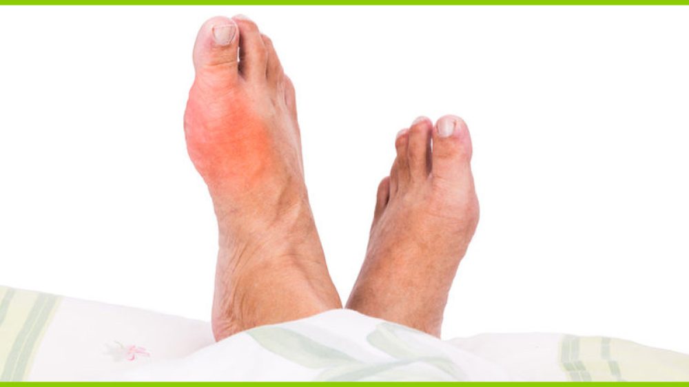 Was ist ein Hallux rigidus?